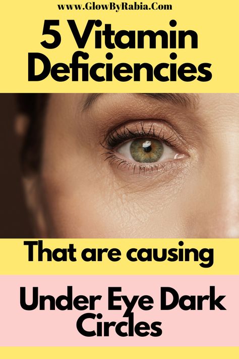 What Helps Dark Circles Under Eyes, Dark Bags Under Eyes, Black Eye Circles, Under Eye Dark Circles, Eye Dark Circles, Dark Circle Remedies, Sunken Eyes, Hormonal Health, Bags Makeup