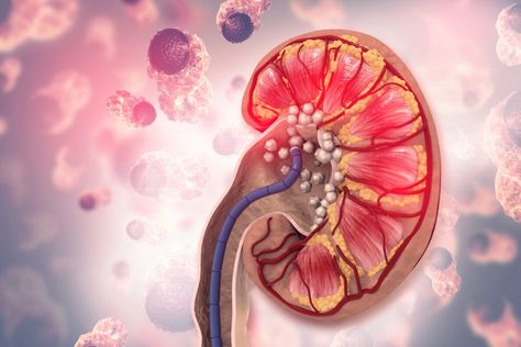 A man in his 60s suddenly felt discomfort in his lower back, and soon after he was so ... Renal Calculi, Kidney Pain, Causes Of Back Pain, Kidney Stone, Frequent Urination, Metabolic Disorders, Calcium Supplements, Uric Acid, Animal Protein