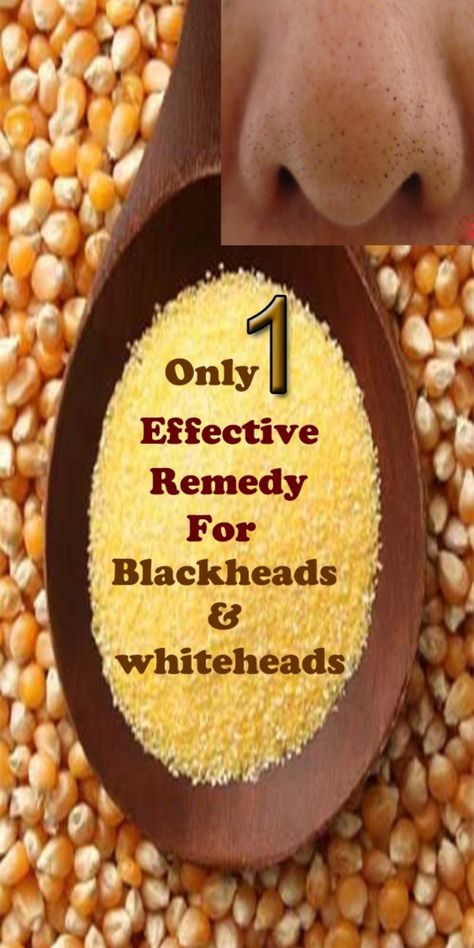 I am going to tell you how you can get rid of your blackheads and whiteheads permanently. Use this one ingredient to get rid of blackheads. Trust me, this remedy actually works to remove blackheads and whiteheads.Try it Whiteheads Removal Remedies Home, How To Get Rid Of Whiteheads, Whiteheads Removal Remedies, How To Get Rid Of Blackheads, How To Remove Whiteheads, Low Sugar Dinner Recipes, Remove Whiteheads, Whiteheads Removal, Facial Remedies