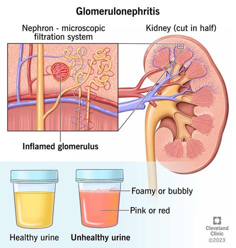 What Is Glomerulonephritis? Acute Glomerulonephritis, Nursing Cheat Sheet, Nephrotic Syndrome, Nursing Cheat, Kidney Damage, Decrease Inflammation, Menstrual Health, Cleveland Clinic, Medical Illustration