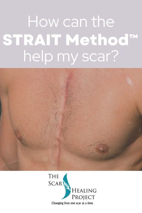 STRAIT Method™ therapy begins with a series of fascial techniques that release and realign the restrictive tissue from the starting point (visible scar) to the endpoint (where the line of frozen fascia stops). You experience relief from the years of pain you’ve endured by finally addressing your adhesions and scars. #thescarhealingproject #scars #straitmethod #massagetherapy #massage #clinicalmassage #scartissuerelease #scartherapy #healingfromscars Scar Tissue Massage, Balanced Life, Scar Tissue, Holistic Approach, Healing Journey, Mental Wellness, Massage Therapy, Life Balance, Mind Body