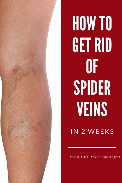 Home Remedies For Spiders, Varicose Vein Removal, Get Rid Of Spiders, Varicose Vein Remedy, Vein Removal, Creme Anti Age, Natural Home Remedies, Natural Treatments, My Health