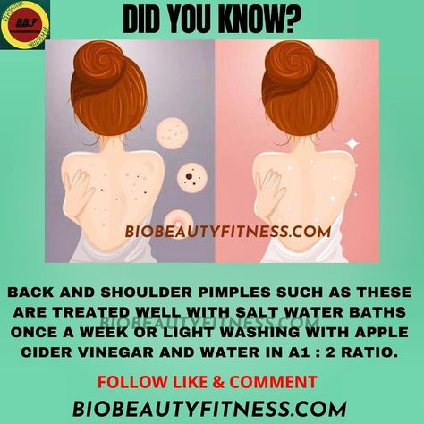 How To Hide Pimples, Overnight Pimple Remedies, Pimple Under The Skin, Homemade Pimple Remedies, Pimple Scar Removal, Natural Remedies For Pimples, Back Pimples, Pimple Solution, Pimple Free Skin