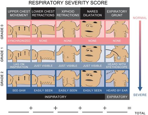 The Silverman-Anderson index is used to score an infant's degree of respiratory efficiency. The score for the individual criteria matches the grade. A total score of 0 indicates no obvious distress while a score of 10 indicates severe distress. Nicu Nurse Education, Medical Diagrams, Nursing Tools, Nurse Education, Emt Study, Nursing Cheat Sheet, Paramedic School, Nursing Cheat, Nursing Study Guide