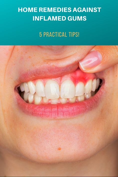 Reference Ideas, Tongue Health, Health Signs, Cold Sores Remedies, Hygiene Care, Stronger Teeth, Natural Sleep Remedies, Oral Care Routine, Receding Gums