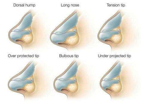 Pimple Inside Nose, Acne On Nose, Anatomy Head, Nose Surgery Rhinoplasty, Nose Types, Rhinoplasty Nose Jobs, Nose Reshaping, Rhinoplasty Surgery, Pretty Nose