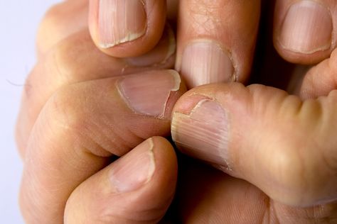 Split Nails, Cracked Nails, With Nails, Brittle Nails, Nail Fungus, Dry Nails, Nailed It, Healthy Nails, Homemade Beauty Products