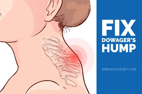 Learn what causes some people to develop a hump on their neck and how to fix it using the best dowager's hump exercises. READ MORE. Hump On Neck, Neck Hump Exercises For Women, Dowagers Neck Exercises, How To Fix Neck Hump, Hump On Back Of Neck, Fix Neck Hump, Dowagers Hump, Dowager Hump, Dowager's Hump