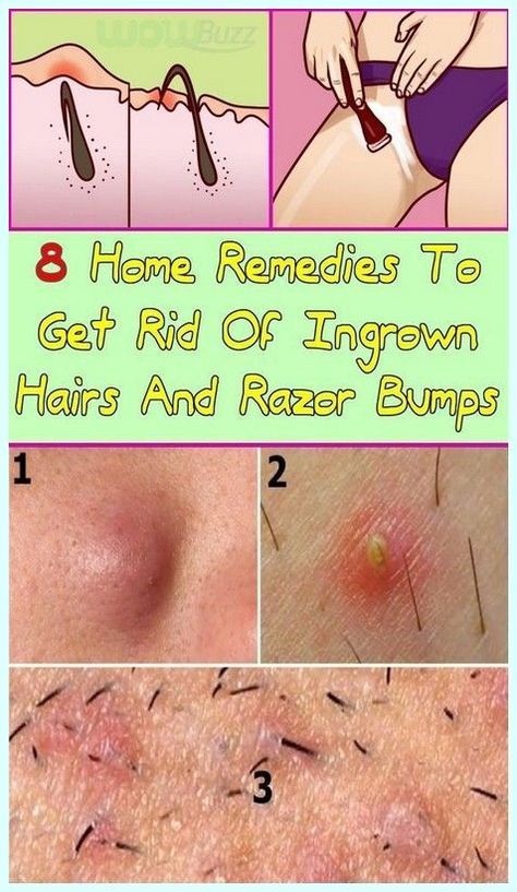 Great Trick With Which You Will No Longer Have Ingrown Hairs After Shaving Treat Ingrown Hair, Ingrown Hair Remedies, Skin Bumps, Skin Care Routine For 20s, Hair Growing, Unwanted Facial Hair, Hair Curls, Razor Bumps, Ingrown Hairs