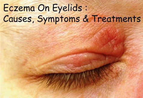 Eczema On Eyelids : Causes, Symptoms & Treatments | Disfreeskin Dry Eyelids Remedy, Dry Eye Remedies, Itchy Eyelids, Dry Eyelids, Dry Eye, Itchy Eyes, Home Health Remedies, Health Board, Itchy Skin