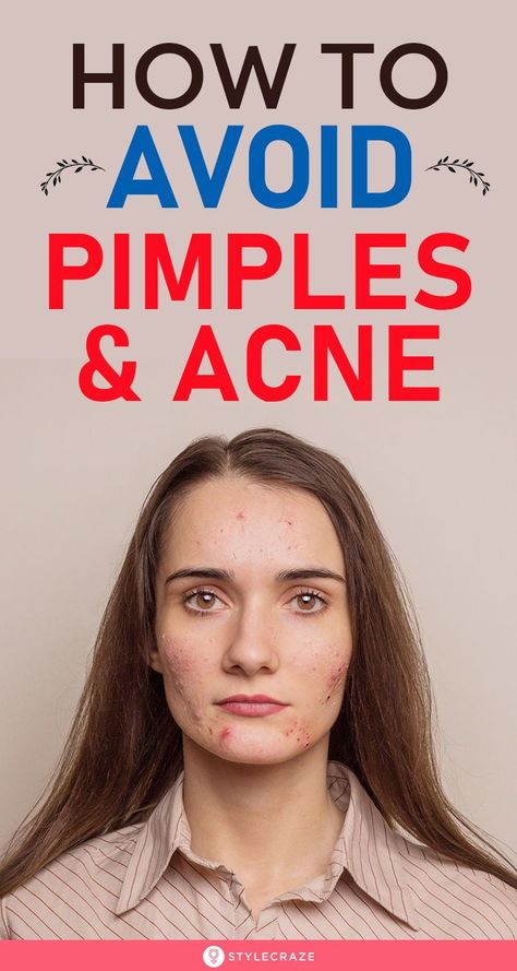 How To Avoid Pimples And Acne: You need a systematic approach involving self-care, lifestyle and diet changes, and a thorough skin care routine to prevent and get rid of pimples. In this article, we have discussed the causes of pimples and tips and remedies to prevent them. #Beauty #BeautyTips #Acne #Pimples How To Avoid Pimples, Causes Of Pimples, Pimple Causes, Get Rid Of Pimples, Blind Pimple, Rid Of Pimples, Diet Changes, Pimples Under The Skin, Bad Acne