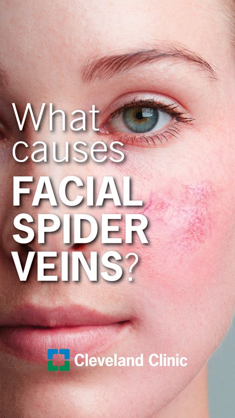 What causes spider veins on your face + how to treat it.  #skincare #skinhealth #dermatology #health Spider Vein Remedies, Blood Vessels On Face, Scalp Spa, Facial Veins, Get Rid Of Spiders, Vein Removal, Hair Detox, Under Eyes, Unwanted Hair Removal