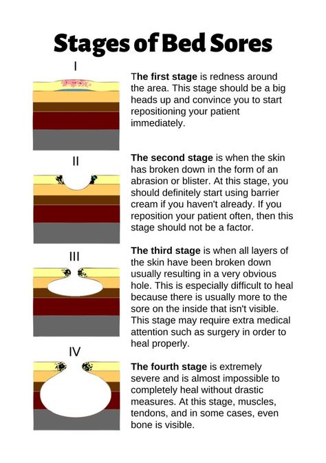 This infographic explains the four stages of bed sores also known as pressure ulcers which is the breakdown of skin when patients are on bedrest or immobile for long periods of time and are not repositioned properly or often enough. Nursing School Studying Cheat Sheets, Nurse Skills, Bed Sores, Pressure Ulcer, Natural Remedies For Migraines, Certified Nursing Assistant, Nursing School Notes, Medical School Essentials, Human Anatomy And Physiology