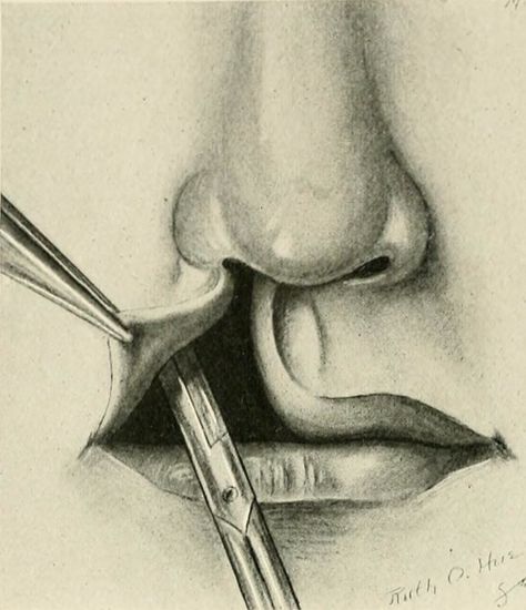 Image from page 543 of "The practice of surgery" (1910) | Flickr Maxillofacial Surgery Wallpaper, Surgery Art, Columbia University Library, The Surgeon, Nose Surgery, Reconstructive Surgery, Columbia University, Surgery, Illustration Art