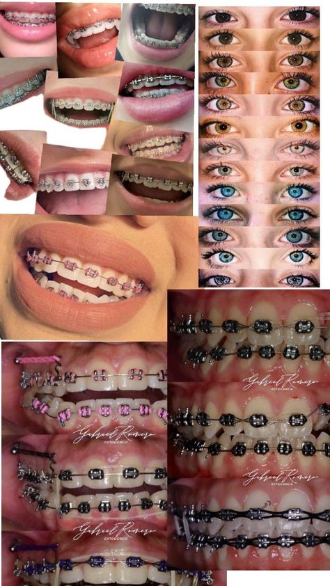 Braces Colors Christmas, Cute Braces Colors Combinations, Braces On Crooked Teeth, Braces Aesthetic Colors, Braces With Rubber Bands, Teeth Types, Power Chain Braces, Braces Colors Combinations, Red Braces