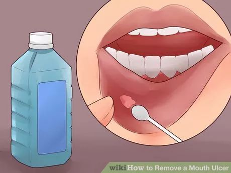 Mouth Blister Remedy, Sore In Mouth Remedies, Blister In Mouth, Ulcer On Tongue, Blister Remedies, Mouth Blisters, Ulcer Remedies Mouth, Canker Sore Remedy, Mouth Ulcer