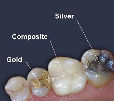 Composite Fillings, Amalgam Fillings, Dental Bonding, Tooth Filling, Soft Tissue Injury, Dental Fillings, Dental Surgeon, Beautiful Teeth, Dental Emergency