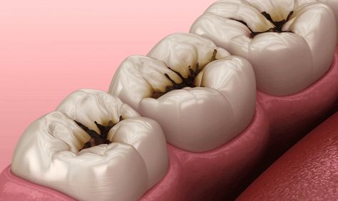 A tooth cavity, or dental caries or decay, is a localized area of damage to the tooth’s hard tissues, primarily caused by bacterial activity. When sugars and starches in food interact with bacteria in the mouth, they produce acid that erodes the tooth enamel. Over time, this process leads to the formation of cavities, compromising the tooth’s structure. Tooth Caries, Dental Pictures, Dental Advertising, Dental Images, Dental Decay, Tooth Cavity, Dental Videos, Dental Health Care, Dental Cavities