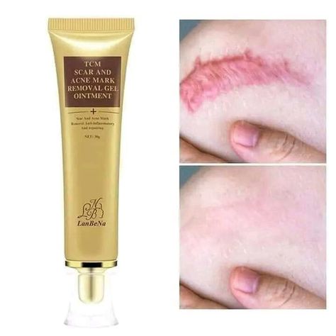 Acne Scar Cream, Acne Mark Removal, Acne Scar Removal Cream, Scar Remover, Scar Removal Cream, Scar Cream, Pimples On Face, Acne Gel, Learn Makeup