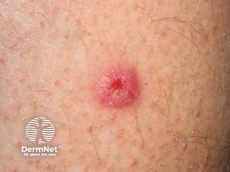 Squamous cell carcinoma of limbs images Squamous Carcinoma, Basil Cell Carcinoma, Skin Symptoms, Heat Rash, Skin Rashes, Squamous Cell, Basil, New Zealand, Skin