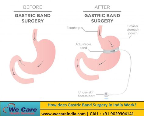 India is a country where you will get the reasonable and affordable cost for gastric banding surgery which is around USD 3,500 which is quite reasonable as compared to the gastric banding surgery in other developed countries like the USA, UK, Australia, Russia, etc. Dr Mario, Lap Band, Gastric Band, Bariatric Surgeon, Dancers Body, Sleeve Gastrectomy, Sleeve Surgery, Types Of Surgery, Vagus Nerve