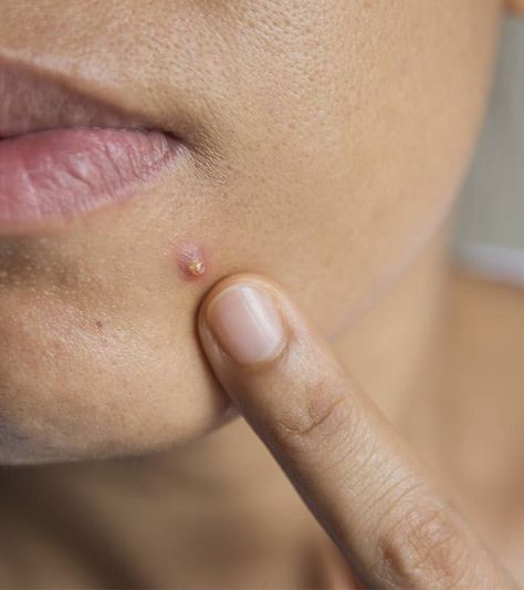 5 Best Home Remedies For Cystic Acne | Causes And Prevention #acne #pimples #pimplesremedies #acneremedies #skincarediy. https://whispers-in-the-wind.com/combatting-pimples-under-the-skin-expert-tips-and-product-recommendations/?106 Cystic Acne On Chin, Face Hacks, Pimples On Buttocks, Back Acne Remedies, Cystic Acne Remedies, Cystic Pimple, Pimples Under The Skin, Pimples Remedies, Natural Acne Remedies