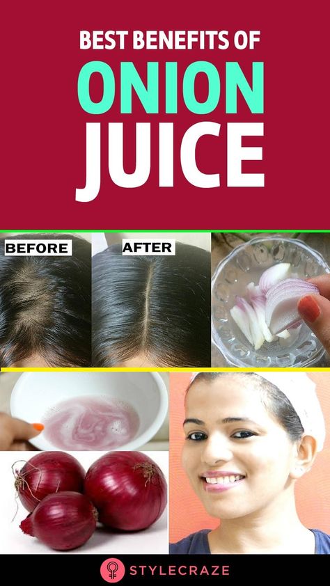 Red Onion Benefits, Garlic For Hair Growth, Juice For Hair, Onion Benefits, Onion Juice For Hair, Hair Grow Faster, Garlic Juice, Onion For Hair, Onion Juice