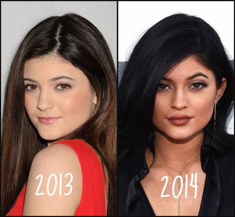 Kylie Jenner #KylieJenner #Beautiful #Celebrity #Stunning #FacePic #BeforeAndAfter Wide Lips, Botox Brow Lift, Jenner Girls, Kylie Jenner Pictures, Kylie Jenner Lips, Jenner Makeup, Facial Fillers, Diy Beauty Treatments, Celebrity Plastic Surgery