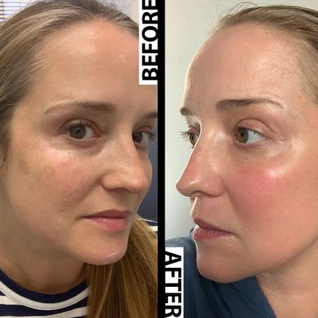 Before And After Some Image Fraxel Laser Before And After, Fraxel Laser, Face Laser, Skincare Wishlist, Remove Skin Tags Naturally, Laser Facial, Skin Peel, Laser Skin Resurfacing, Fractional Laser