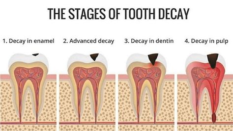 Wisdom Teeth Swelling, Oral Health Education, Dental Decay, Tooth Cavity, Tooth Repair, Teeth Whitening Homemade, Heal Cavities, Dental Emergency, Dental Surgery