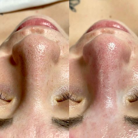 Before and After with the bt-micro.💙 Take a look at @sacred_skin_facials superb extraction results using her bt-micro handheld for professional extractions.✨ #biotherapeutic #btmicro #skincare #extractions #cleanpores #beauty #satisfying #aesthetic #skincareproducts #skincare #dermalogica Facial Extractions, Facial Before And After, Celebrity Plastic Surgery, Clean Pores, Beautiful Love Pictures, Ideal Client, Facial Skin, Esthetician, Plastic Surgery