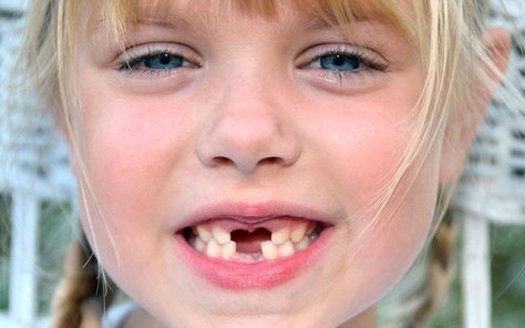 First Tooth Loss Ideas, First Lost Tooth Necklace, Loose Tooth Removal Kid, Smile Tips, Baby Tooth Decay, Losing Teeth, Tiger Showing Teeth, Bad Teeth, Front Teeth