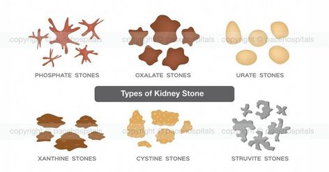 A kidney stone may not cause symptoms until it moves around within your kidney or passes into your ureter. Kidney stones that can Kidney Stone Pain Relief, Kidney Problems Signs, Kidney Stone, Kidney Damage, Uric Acid, Baking Soda Shampoo, Kidney Health, Body Organs, Diy Beauty Hacks