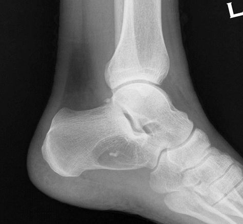 Calcaneal lipoma with Cockade sign | Radiology Case | Radiopaedia.org Brutal Obsession, Manual Muscle Testing, Ankle Fracture, The Badge, Gold Ring Designs, Mehendi Designs, Radiology, X Ray, Back Tattoo