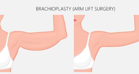 Arm Surgery Plastic Before After, Arm Lift Surgery Before And After, Arm Lift Surgery, Body Lift Surgery, Arm Flab, Arm Toning Exercises, Arm Lift, Reading Diy, Surgery Recovery