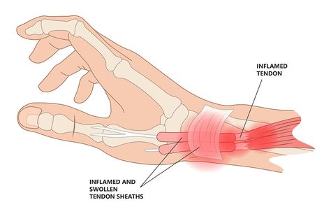 De Quervain Tenosynovitis, Dental Education, Hand Health, Health Disease, Reconstructive Surgery, Dental Instruments, Holistic Remedies, Post Surgery, Dental Hygiene