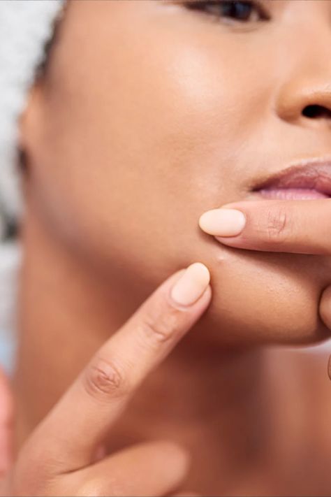 There’s something extra agitating about seeing pimples sprout on the chin as opposed to other spots on the face. Although it might seem like a random spot to break out, there are some pretty practical reasons behind it. Hormonal acne in women is commonly found on the chin, and it can be a tricky battle to beat it, but these tips from the experts can help. Why Do I Have Pimples On My Chin, Bumps On Chin Not Acne, How To Fix Hormonal Acne, Cystic Acne On Chin, Closed Comedones, Skin Blackheads, Face Breaking Out, Holistic Hormonal Acne, Chin Acne