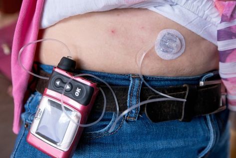 Insulin Pump Aesthetic, T1d Aesthetic, Outter Banks, Blood Sugar Solution, Insulin Pump, Blood Glucose, Blood Glucose Levels, Glucose Levels, Medical Devices