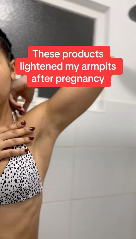 If you're experiencing the sudden and uncomfortable darkening of your underarms during pregnancy, you're not alone. Fortunately, we have a solution for you! Learn how to lighten dark underarms fast and effectively, with our all-natural, pregnancy-safe skincare tips. Say goodbye to hyperpigmentation and hello to a lighter, brighter armpit area. 🌿✨ How To Lighten Armpits, Underarm Darkness, Brighten Underarms, Body Acne Remedies, Hyperpigmentation Remedies, Armpit Whitening, Skin Darkening, Natural Remedies For Migraines, Dark Armpits