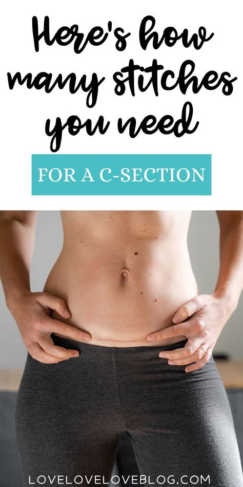 Here's everything that happens during a cesarean section procedure, plus tips for c-section recovery. You'll learn how many stitches are required, how to care for them, and what to expect during postpartum. I also share helpful first time mom tips for labor, delivery, and beyond! First Time Mom Tips, C Section Recovery, Cesarean Section, First Time Mom, Labor Delivery, C Section, Postpartum Care, Mom Tips, First Time Moms