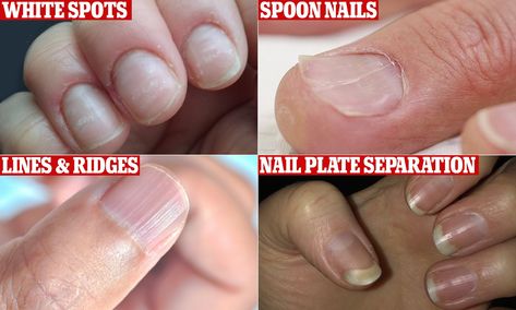 Australian experts reveal common nail problems and what these say about your health Nail Health Problems, Bumpy Nails, Nail Disorders, Nail Conditions, Opal Nails, Nail Problems, Skin Bumps, Popular Nail Designs, Brittle Nails