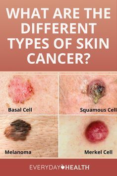 Basal Cell, Skin Moles, Squamous Cell, Types Of Skin, How To Remove Pimples, Everyday Health, Health Planner, Breast Health, Skin Disorders