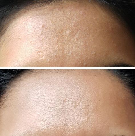 This K-Beauty Liquid Is Going Viral for *Curing* This Woman's Whiteheads  - Cosmopolitan.com Whiteheads Remedy, Whiteheads Removal, Get Rid Of Age Spots, Glossier Lip, Blind Pimple, Pimples Under The Skin, Get Rid Of Wrinkles, Natural Beauty Remedies, Glossier Lip Gloss