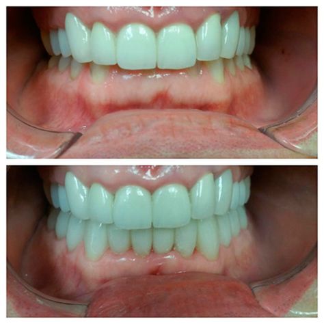 Full lower arch crowns fixing collapsed bite - Before and After Dental Cases, Smile Gallery Dentist in Simi Valley Overbite Before And After, Bad Teeth, Dental Center, Dental Crowns, Simi Valley, Dental Care, Braces, You Deserve, Live Lokai Bracelet