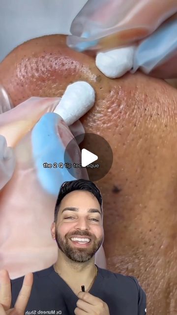 How To Do Extractions On Face, Sebum Removal Clogged Pores, Splinter Removal Video, How To Get Rid Of Sebaceous Filaments, Sebaceous Filaments Removal, Spot Popping Videos, Oddly Satisfying Videos Blackheads, Big Blackheads Removal Satisfying Videos, Huge Blackheads Extraction Videos