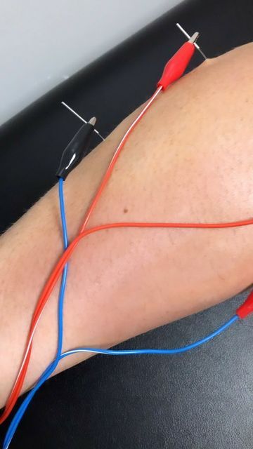 Dry Needling Therapy, Achilles Tendinopathy, Acupuncture Needle, Calf Pain, Golfers Elbow, Knee Pain Exercises, Spa Marketing, Dry Needling, Piriformis Syndrome