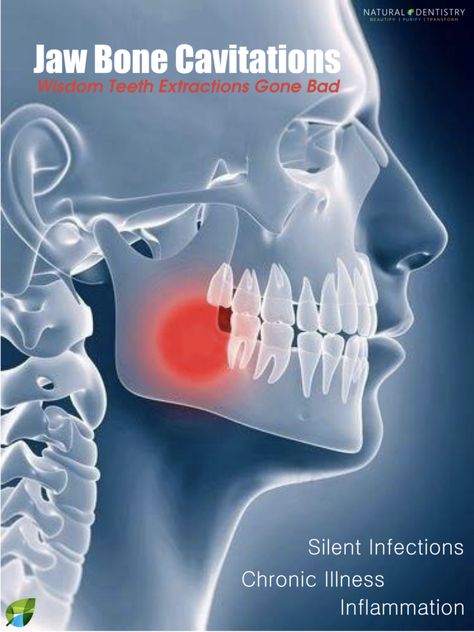 Dental Cavitations Infections Jaw Bone Holistic Dentist Cavitation Surgery Dr. Yuriy May Biological Dentist Cavitations Silent Killers Wisdom Teeth Removal Recovery, Wisdom Teeth Pain Relief, Wisdom Teeth Recovery, Wisdom Teeth Pain, Tooth Pain Relief, Wisdom Teeth Funny, Sensitive Teeth Remedy, Wisdom Tooth Extraction, Dental Implants Cost