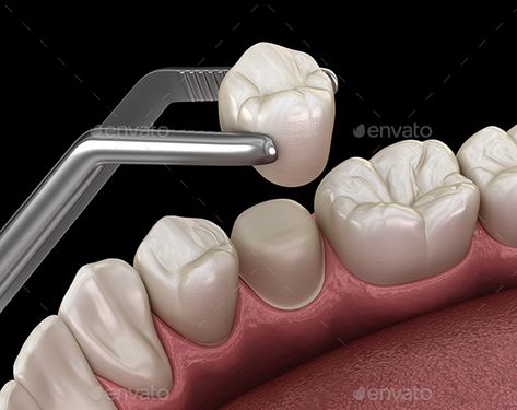 Preparated Premolar Tooth and Dental Crown Placement Dental Advertising, Dental Videos, Dental Crowns, Dental Health, 3d Illustration, Adobe Stock, Crown, Stock Photos, Illustrations