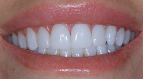 Natural Teeth Whitening Diy, Teeth Whiting At Home, Pretty Teeth, Veneers Teeth, Teeth Whitening Diy, Beautiful Teeth, Teeth Bleaching, Loose Tooth, Front Teeth