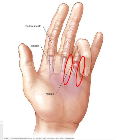 3 Tips to Treat Trigger Finger Yourself ! - REHAB FOR A BETTER LIFE Trigger Finger Exercises, Joints Pain Remedy, Hand Health, Finger Exercises, Trigger Finger, Hand Exercises, Hand Therapy, Natural Health Remedies, Health Info